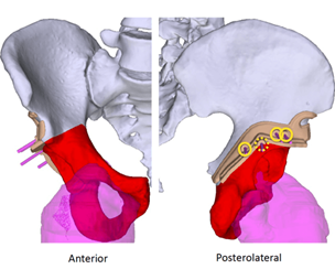 3D custom implants for bone cancer illustration