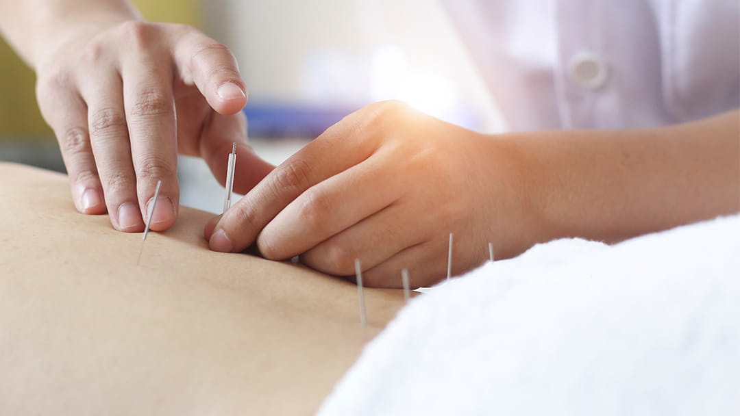 Acupuncture In Orthopedics And Sports Medicine | University Hospitals