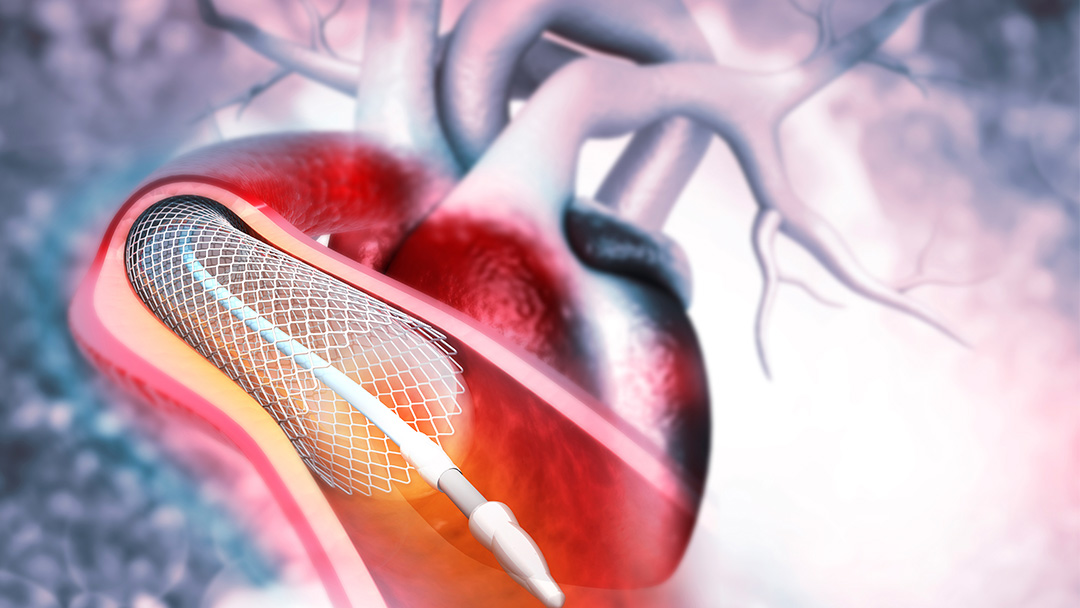 Heart Attack and Stents | University Hospitals