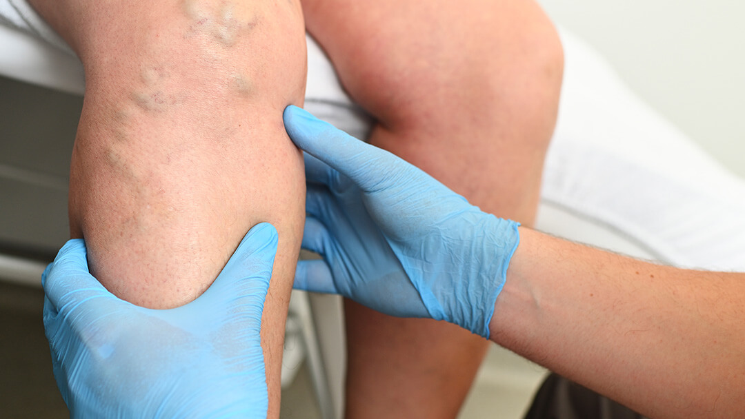 What is difference between spider veins and varicose veins?