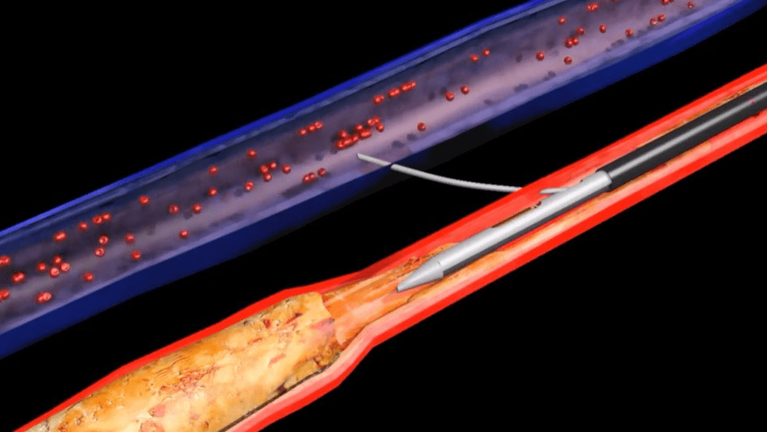 Clinical Trial Procedure Restores Blood Flow Easing Patient S Foot   OpenGraph   LimFlow 