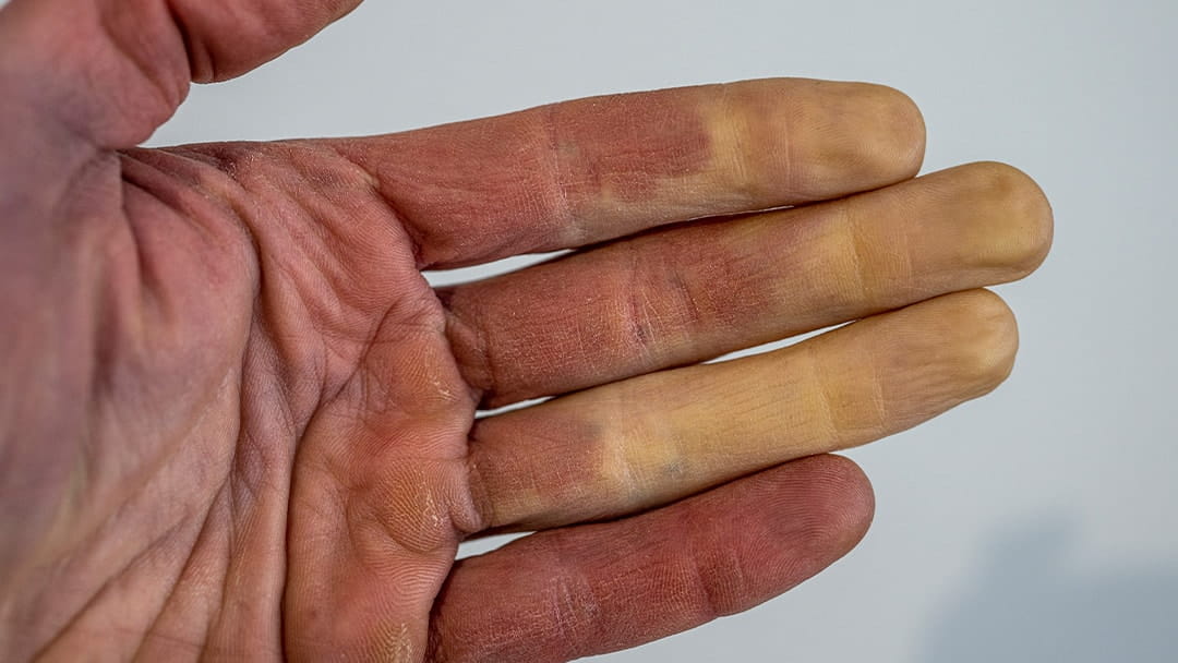 Fingers Turn Blue Or White When Cold It Could Be Raynaud s 