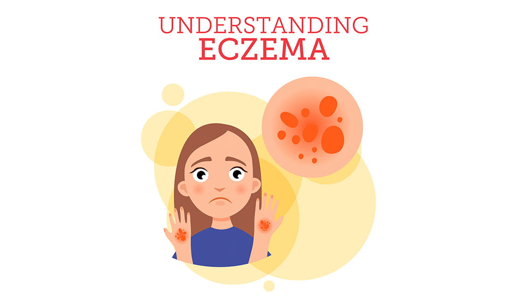 Understanding Eczema in Children | University Hospitals