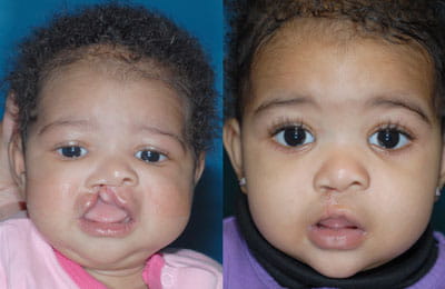 Unilateral Cleft Lip Photo Gallery | Division of Pediatric Plastic ...