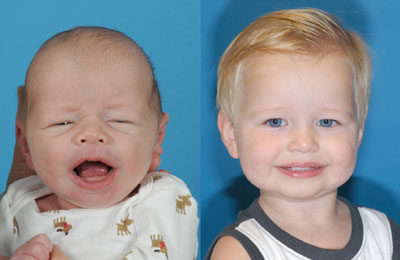 Craniosynostosis Photo Gallery | Division of Pediatric Plastic