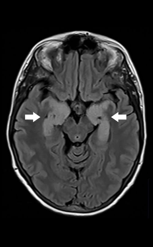 autoimmune-encephalitis-clinic-at-university-hospitals-in-cleveland