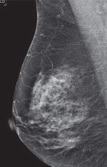 Fibroglandular Density Breast Density Fibrous Tissue Detection At Uh Breast Health Centers University Hospitals