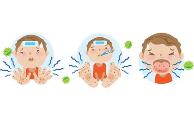 How to Spot and Manage Hand, Foot and Mouth Disease
