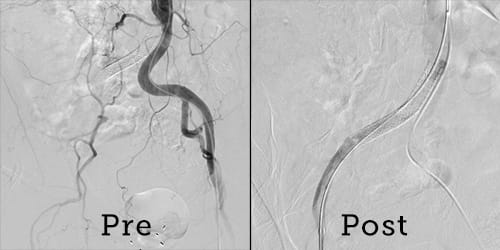 Vascular scans of Daniel Boynton before and after limb salvage