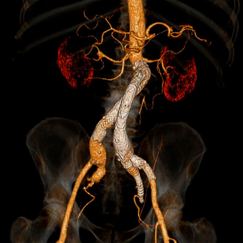 Image of completed endovascular aneurysm repair