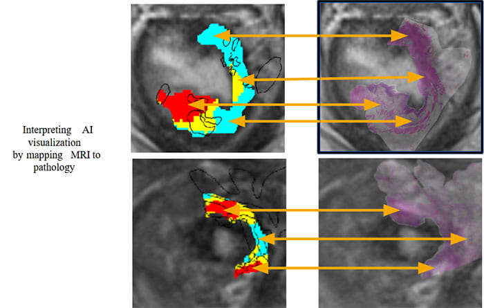 Interpreting AI visualization by mapping MRI to pathology