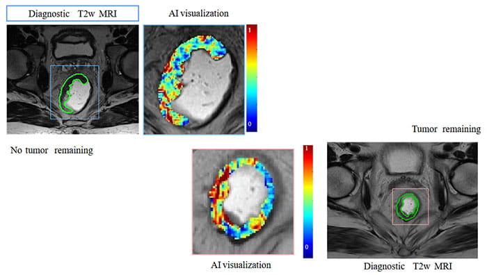 Diagnostic MRI images of colorectal tumors