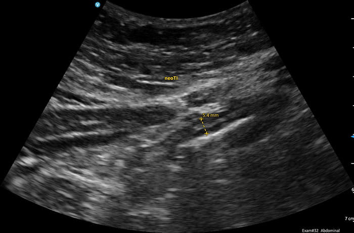 Intestinal Ultrasound of IBD Innovations in DH Fall 2024