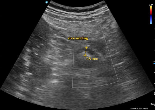 Intestinal Ultrasound of IBD Innovations in DH Fall 2024