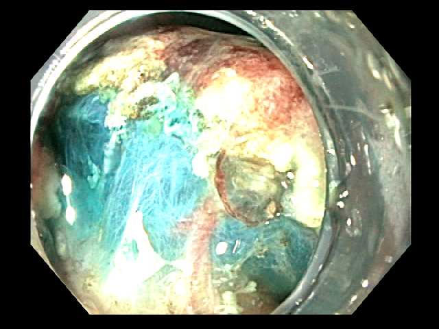 Submucosal dissection is aided by injection of fluid with methylene blue.
