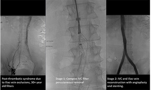 Complex IVC filter removal with IVC and Iliac Vein Reconstruction