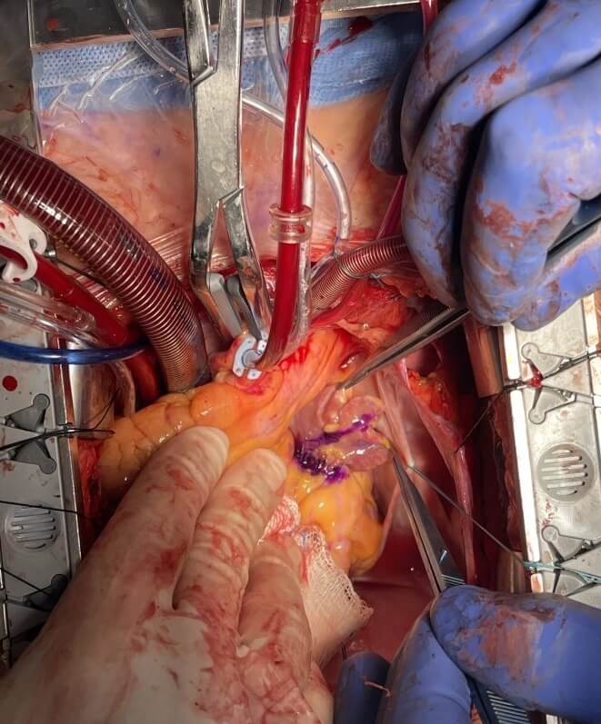 LAA During On-Pump image caption: Exposure of the left atrial appendage during on-pump cardiac surgery.
