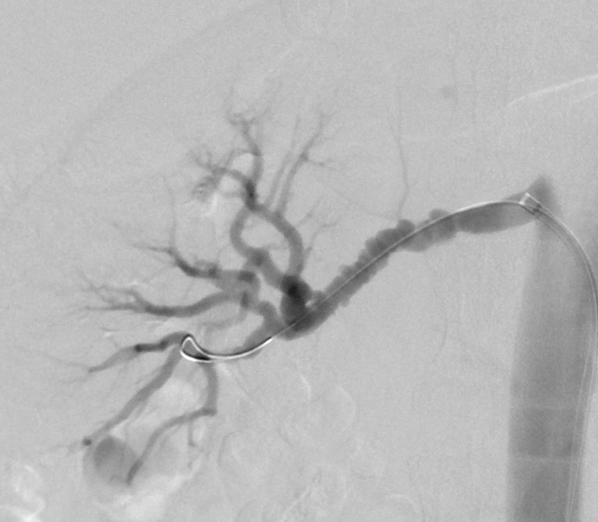 Image of classical "string of beads" of multifocal type FMD in the right renal artery in a patient undergoing an angioplasty procedure for hypertension.