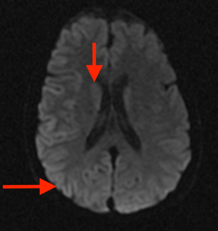Diffusion weighted imaging brain MRI of a patient with prion disease. High intensity signal is present in the cortical ribbon and caudate heads (red arrows).