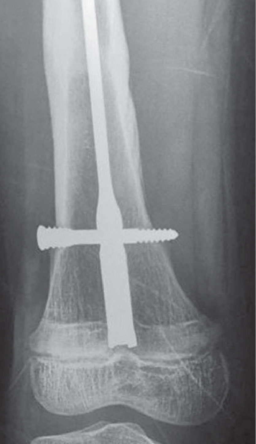 Ortho fracture 1B