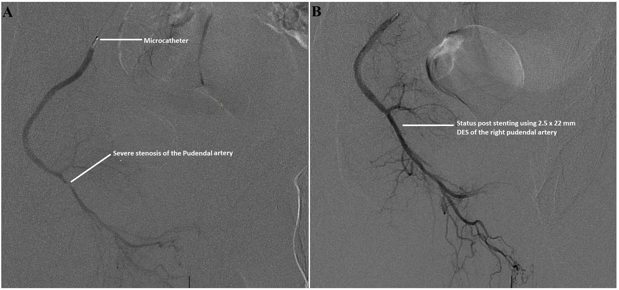 Severe atherosclerotic stenosis of the right pudendal artery