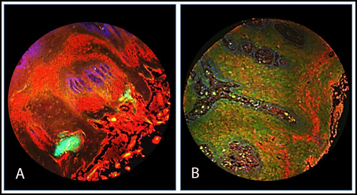 An immunofluorescent picture of a normal tongue compared with stage two tongue cancer. The healthy tongue tissue (A – or left) is stained red by a fluorescent antibody to hBD-2 (the good protein). The cancerous tongue tissue (B – or right) stained green because of overexpression of the protein indicating cancer (fluorescent antibody to hBD-3).