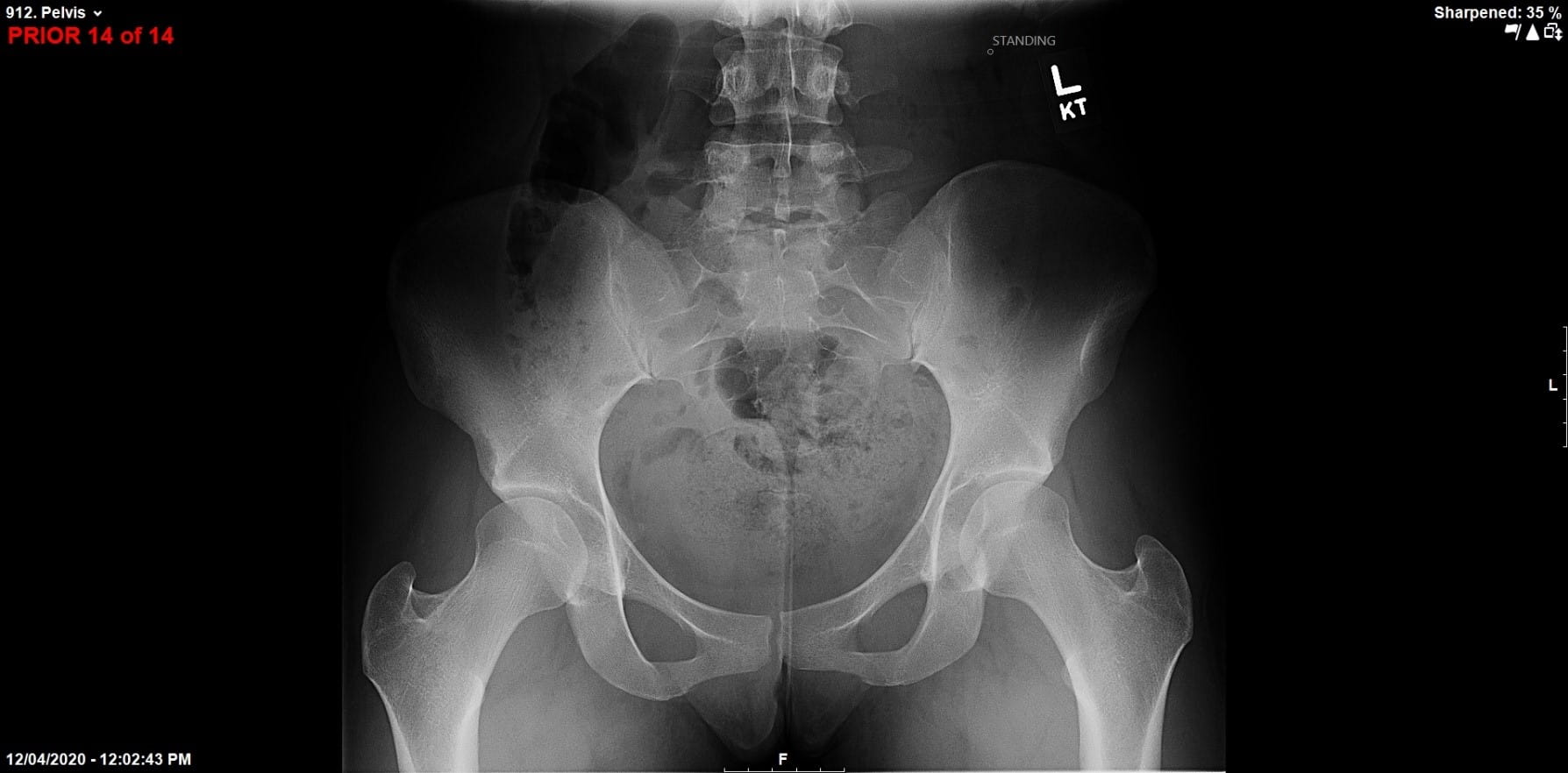 Preop: 20-year-old female with bilateral hip dysplasia and acetabular retroversion and FAI.