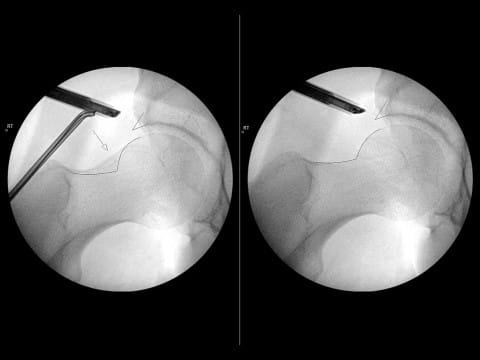 Before and After Intra-op Images of reshaping the femoral head decompression of CAM lesion