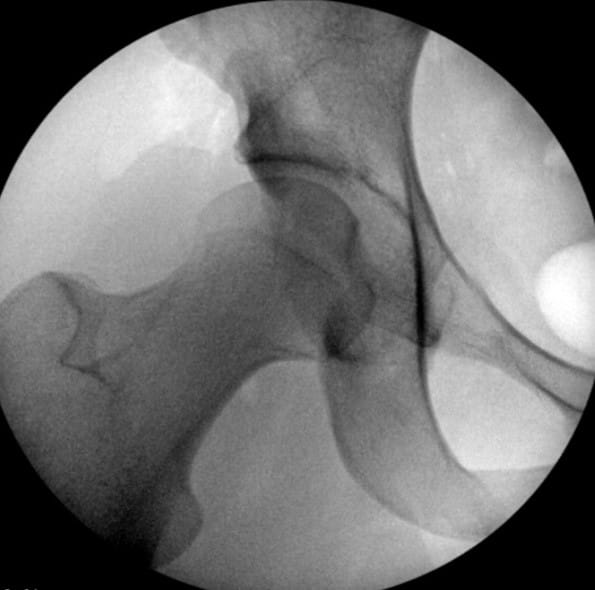 Before Intra-Op Images of PAO correction of the hip socket orientation