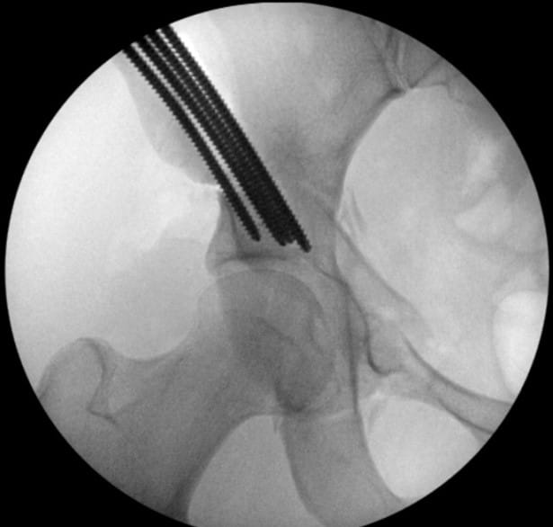 After (2) Intra-Op Images of PAO correction of the hip socket orientation.