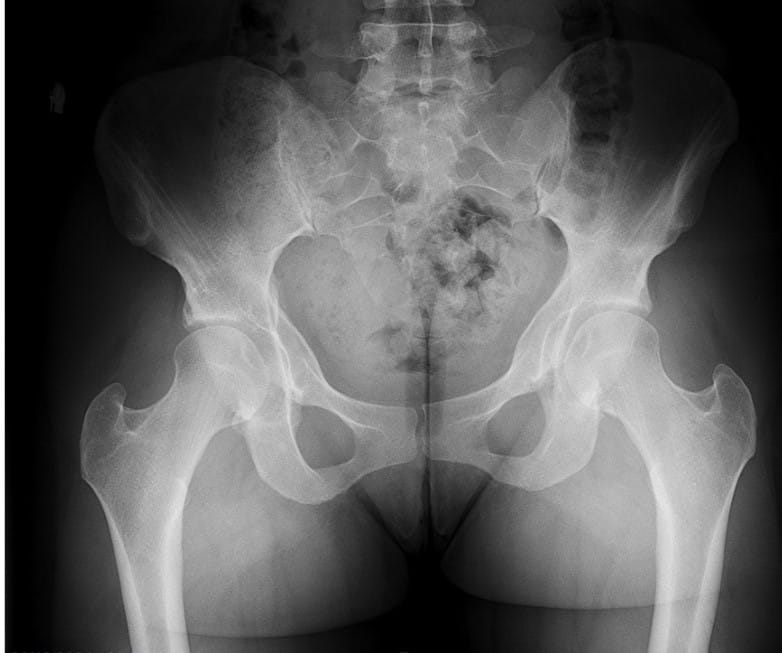 Post-Op Images: 4 years post-op from right-sided combination surgery and 2 years post-op from the left side.