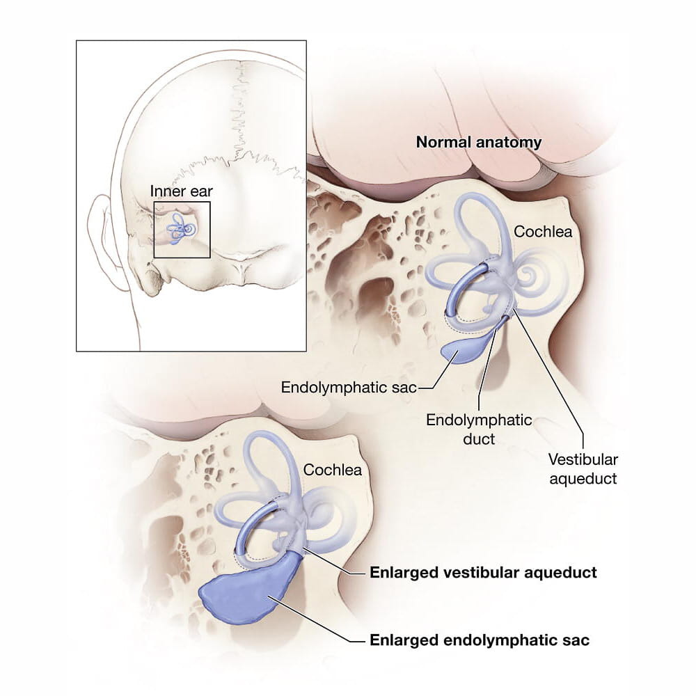 Medical illustration of EVA courtesy of the National Institutes of Health, Department of Health and Human Services