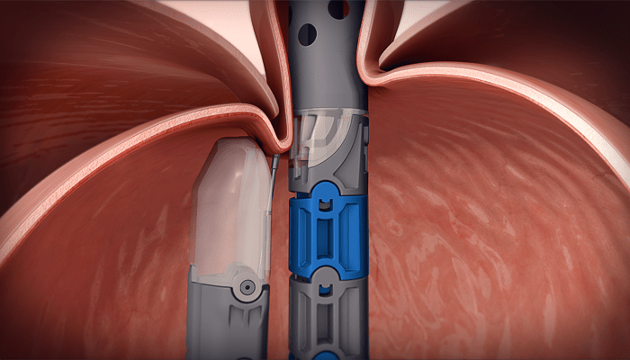 Illustration of a valve repair