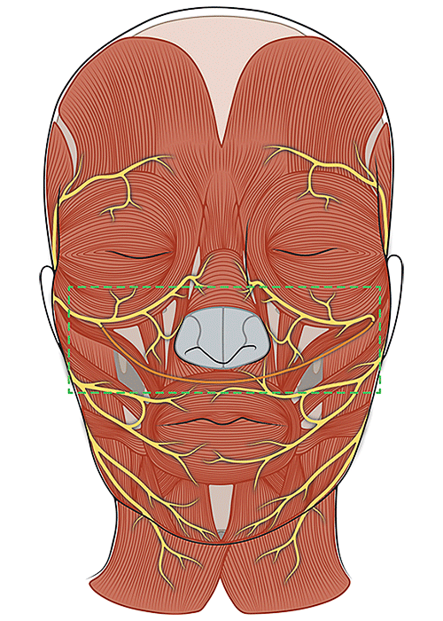 Diagram of a Cross Face Nerve Graft
